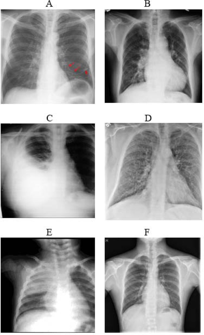 Using Mobile Phones For Computer Aided Detection Of Anomalies On Chest ...