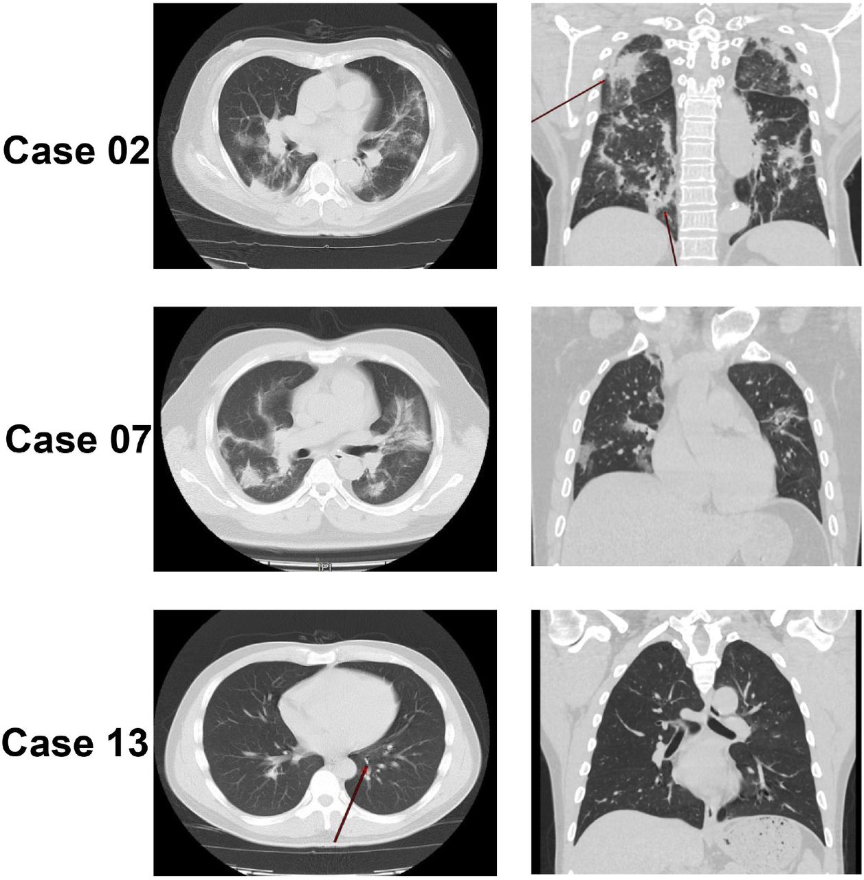 Evaluating The Accuracy Of Different Respiratory Specimens In The Laboratory Diagnosis And Monitoring The Viral Shedding Of 2019 Ncov Infections Medrxiv