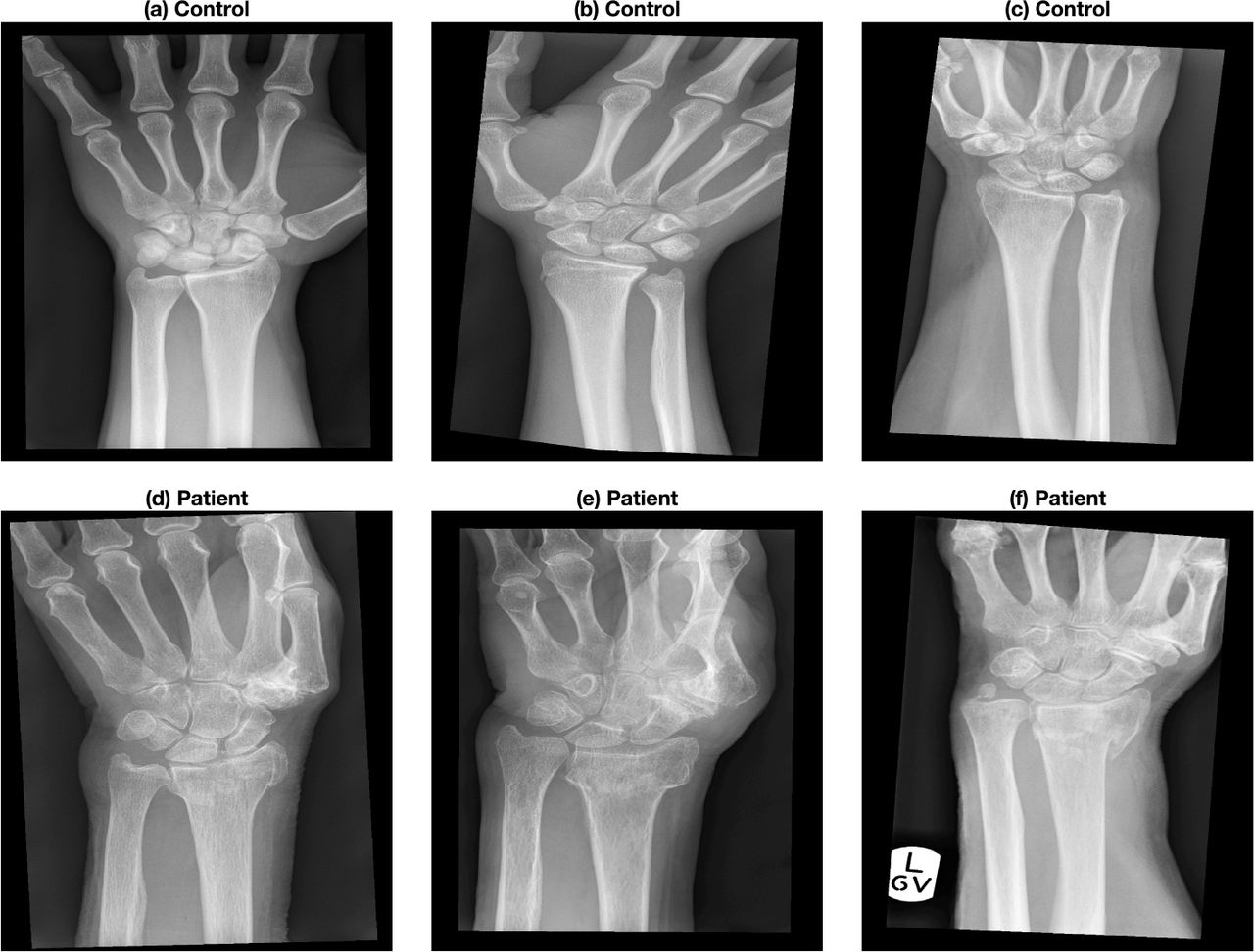 Colle Fracture - Distal Radial Fracture, Radiology Case
