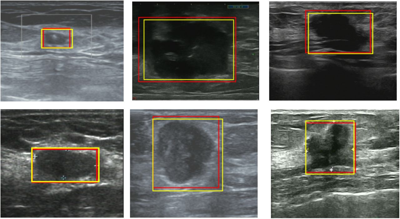 Detection and Recognition of Ultrasound Breast Nodules Based on Semi ...