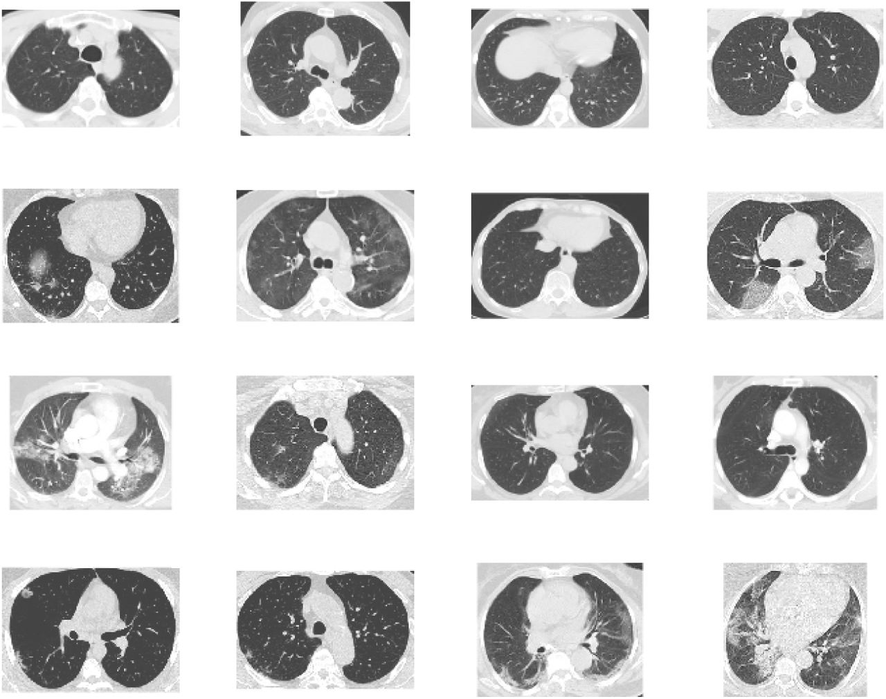 Sars Cov 2 Ct Scan Dataset A Large Dataset Of Real Patients Ct Scans For Sars Cov 2 Identification Medrxiv