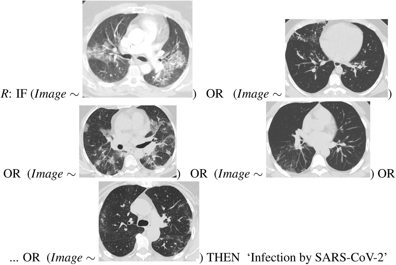 Sars Cov 2 Ct Scan Dataset A Large Dataset Of Real Patients Ct Scans For Sars Cov 2 Identification Medrxiv