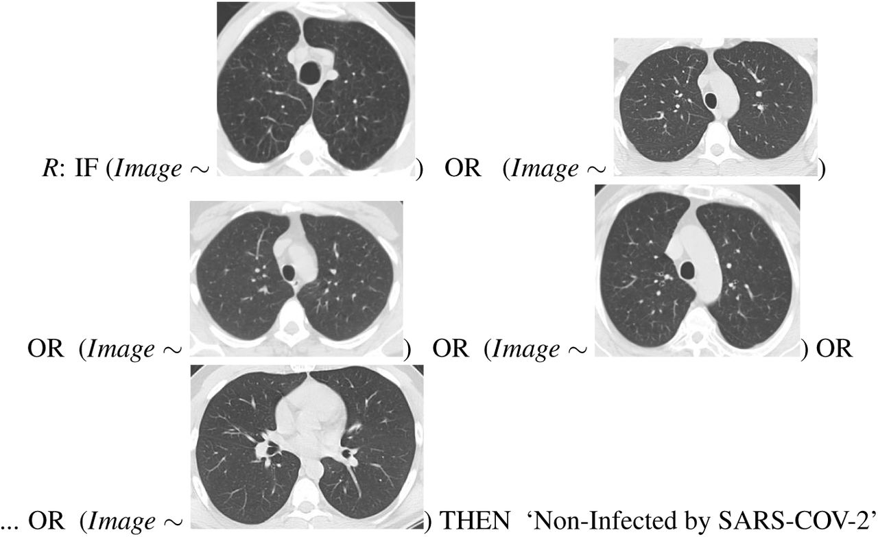 Sars Cov 2 Ct Scan Dataset A Large Dataset Of Real Patients Ct Scans For Sars Cov 2 Identification Medrxiv