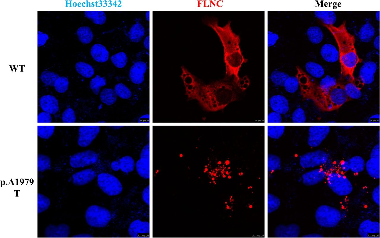 FLNC-Associated Myofibrillar Myopathy