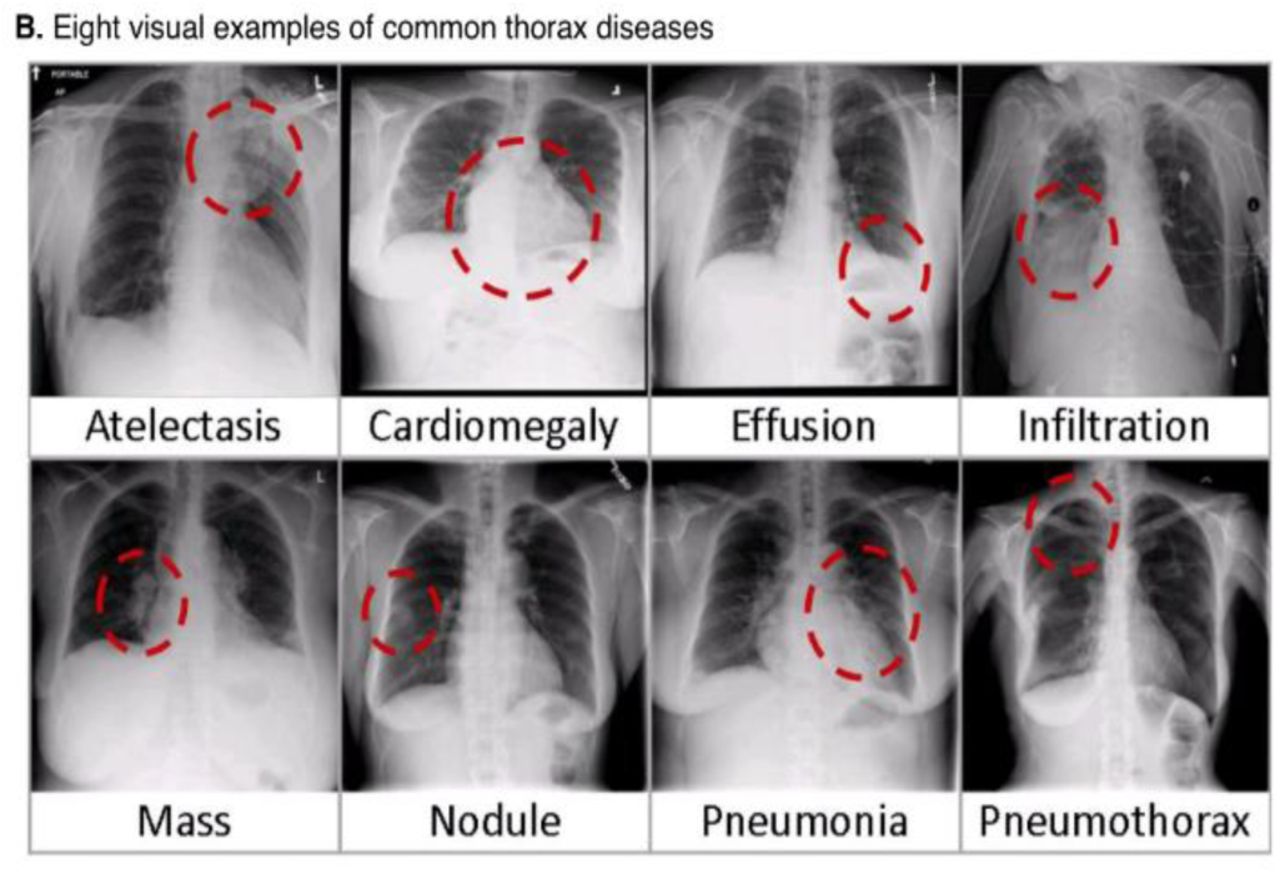 viral pneumonia chest x ray findings