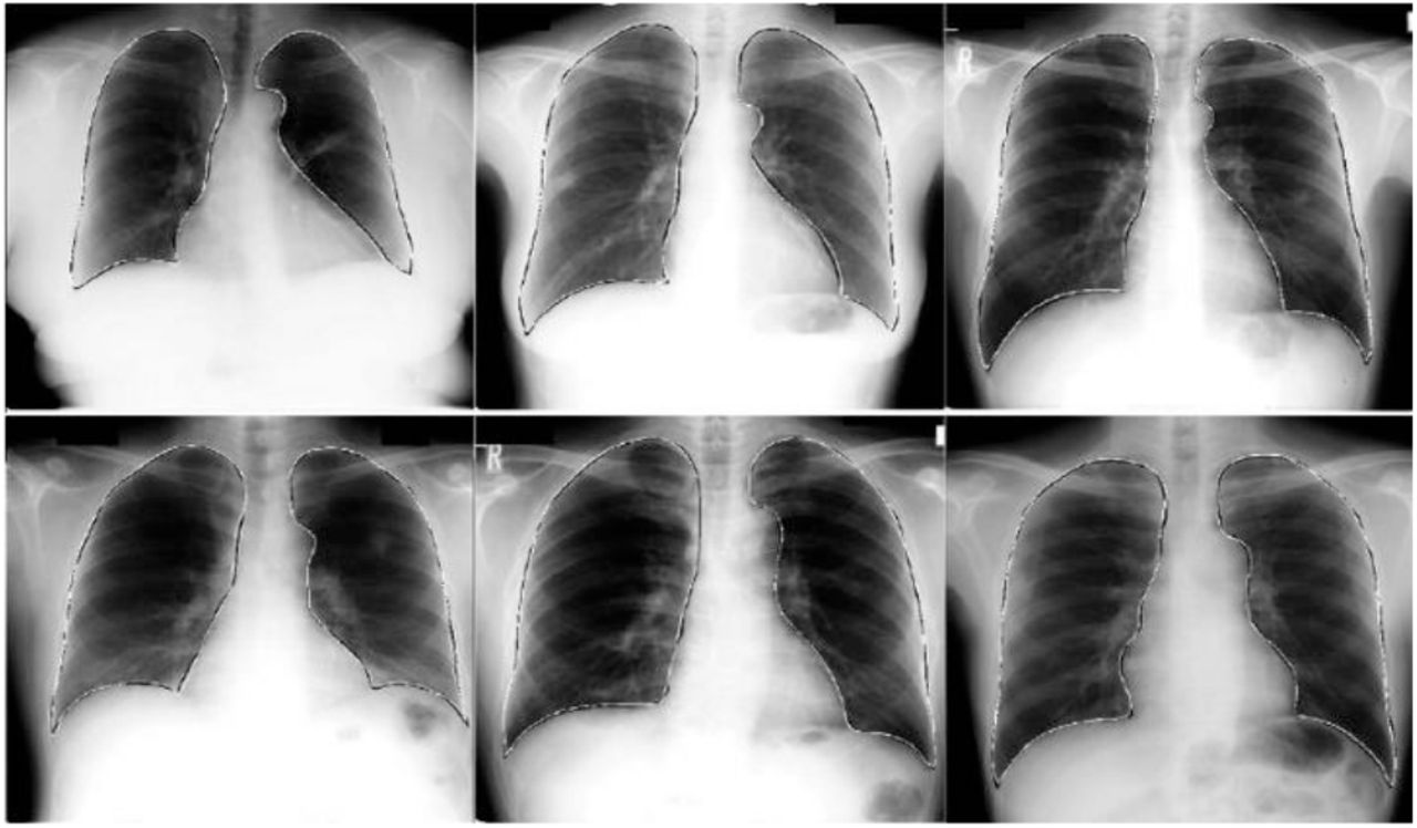 viral pneumonia chest x ray findings