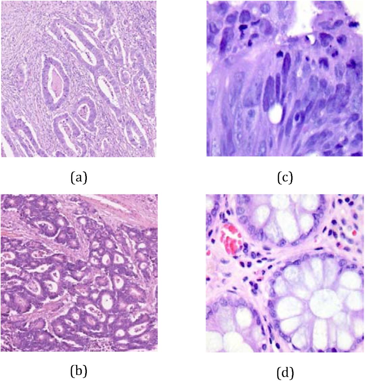 colon adenocarcinoma histology