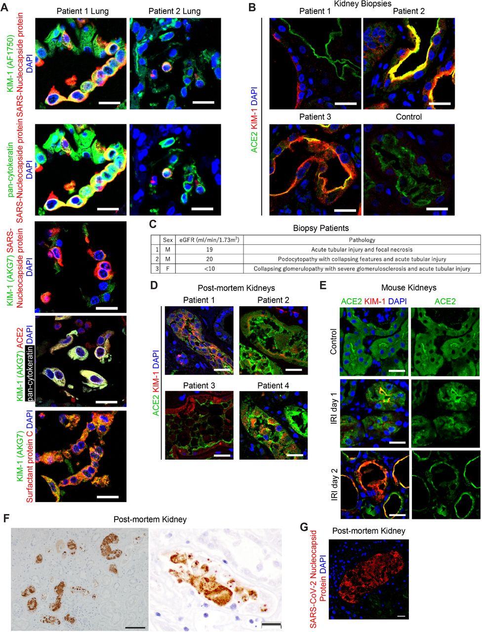 Kim-1 Tim-1 Is A Receptor For Sars-cov-2 In Lung And Kidney 