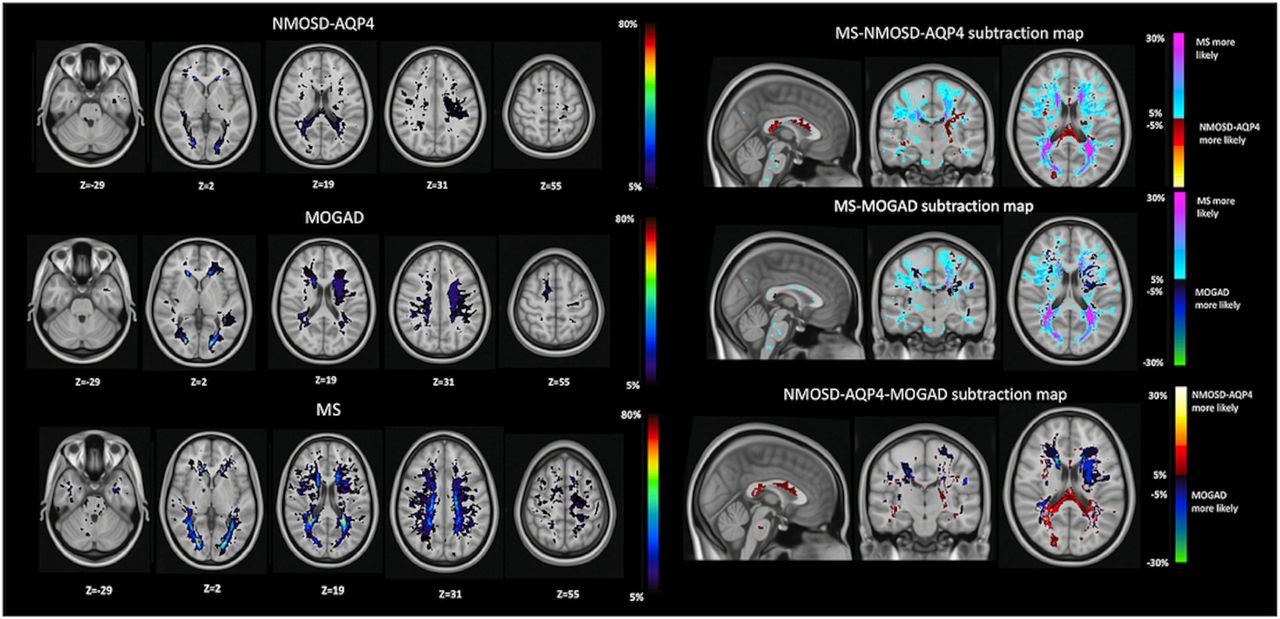 Imaging Surrogates of Disease Activity in Neuromyelitis Optica Allow  Distinction from Multiple Sclerosis