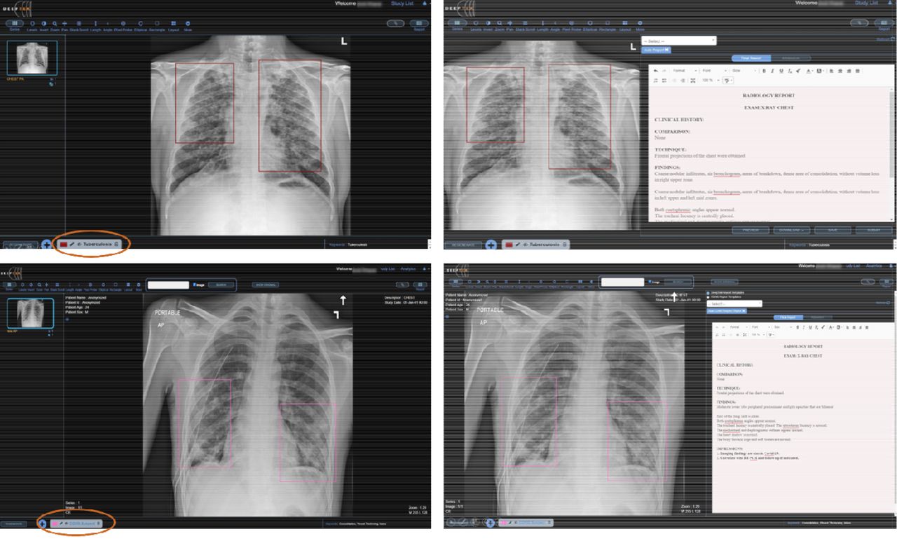 chest x ray tb vs normal