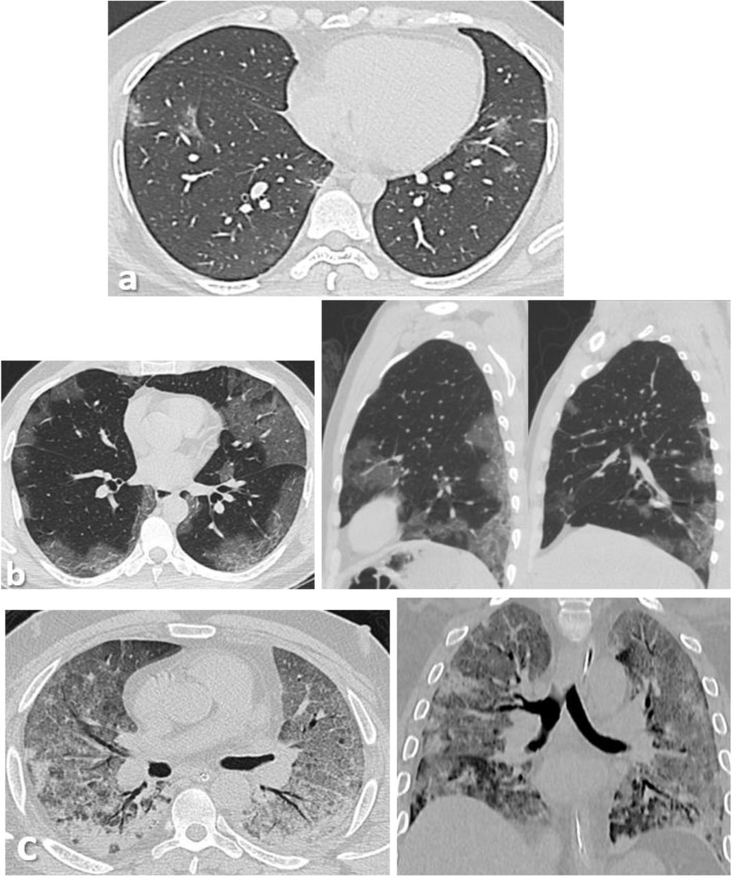 Correlation Between Chest Ct Severity Scores And The Clinical Parameters Of Adult Patients With Covid 19 Pneumonia Medrxiv