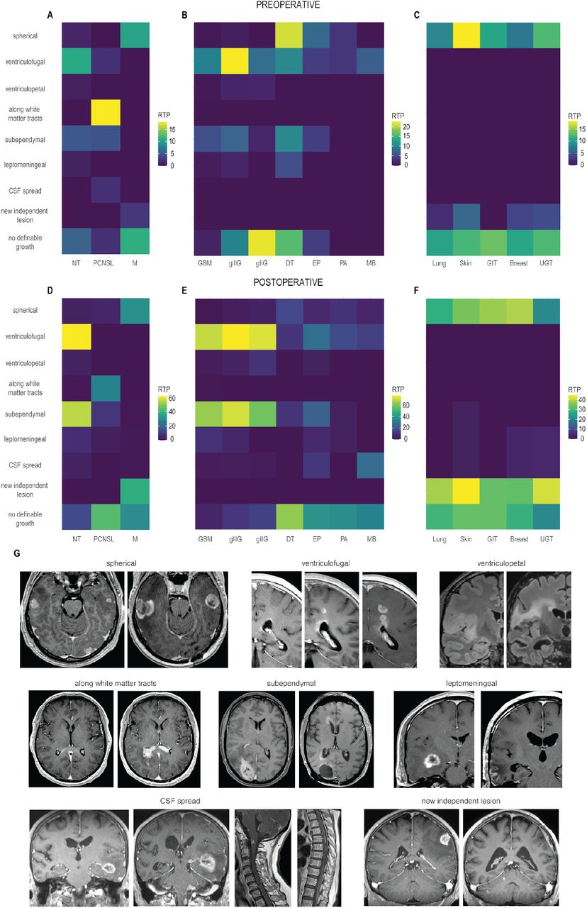 Anatomical Phenotyping And Staging Of Brain Tumors Medrxiv