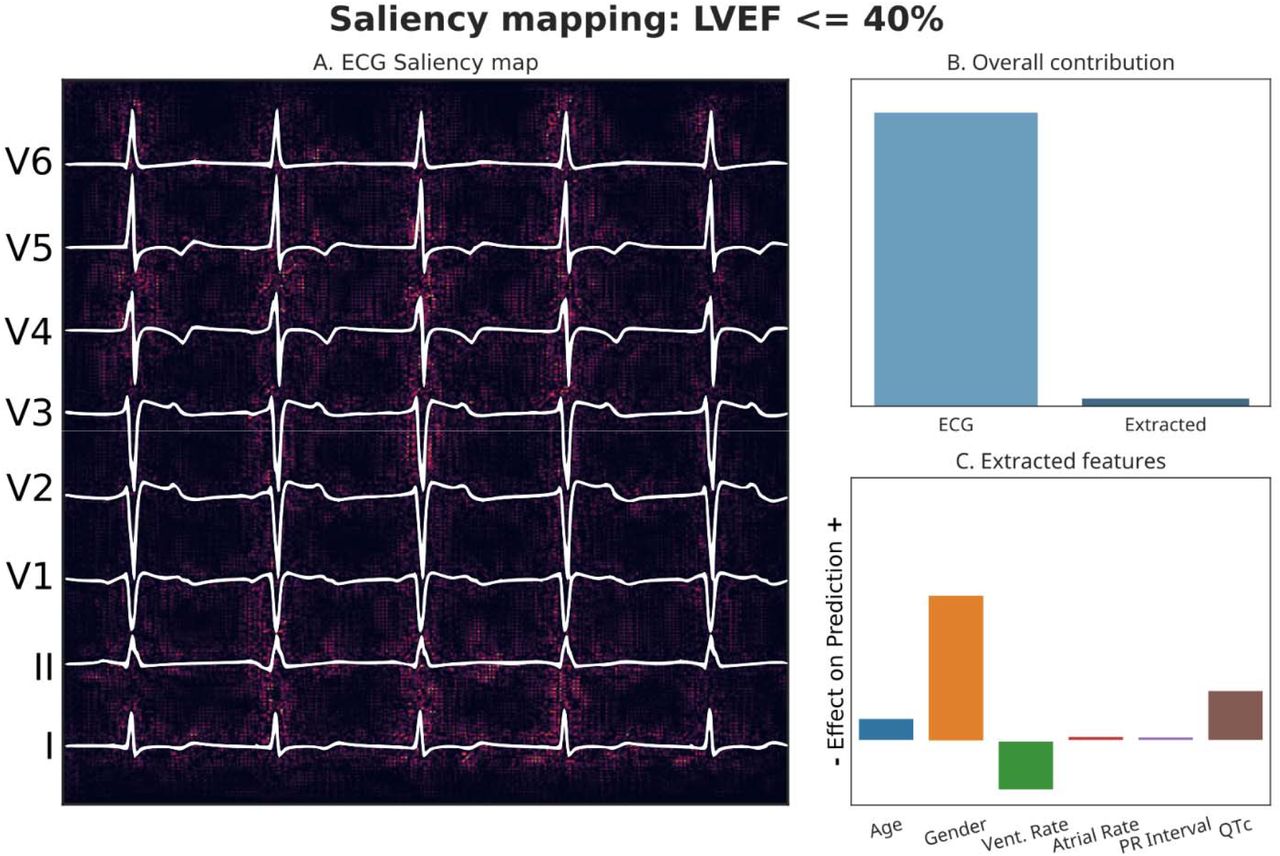Using Deep-Learning Algorithms to Simultaneously Identify Right and Left  Ventricular Dysfunction From the Electrocardiogram - ScienceDirect