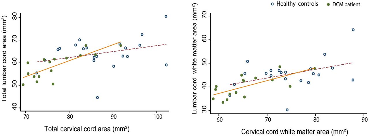 Assessment of degenerative cervical stenosis on T2-weighted MR imaging:  sensitivity to change and reliability of mid-sagittal and axial plane  metrics