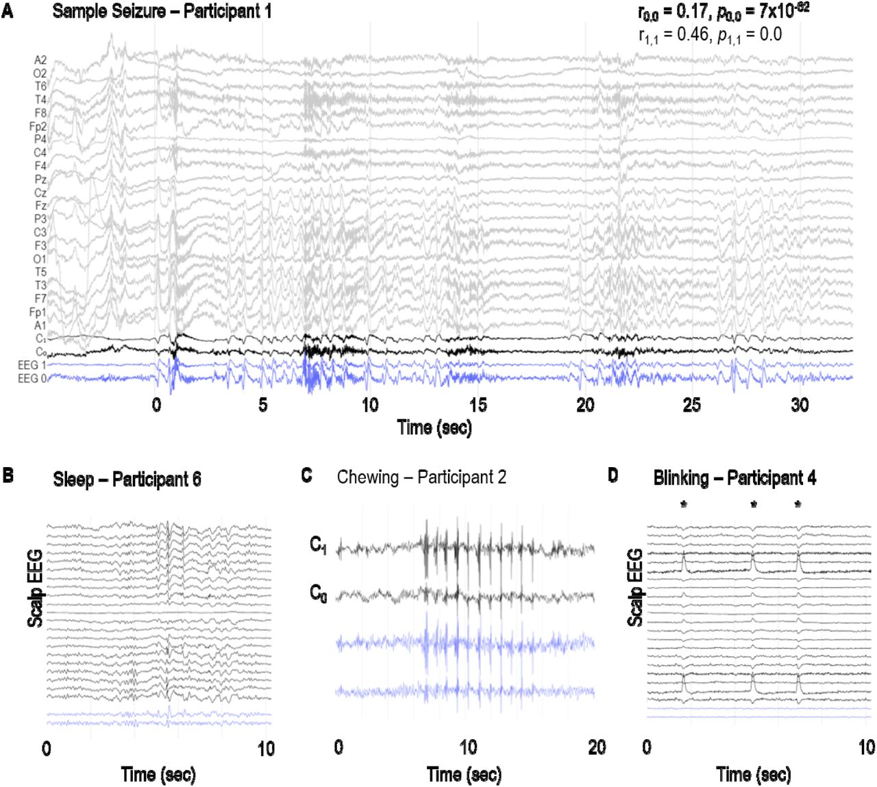 Frontiers  Seizure Forecasting Using a Novel Sub-Scalp Ultra-Long Term EEG  Monitoring System