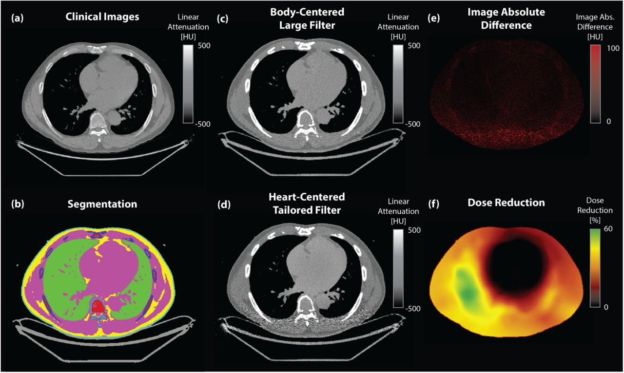 Heart-centered positioning and tailored beam-shaping filtration for reduced  radiation dose in coronary artery calcium imaging: a MESA study | medRxiv