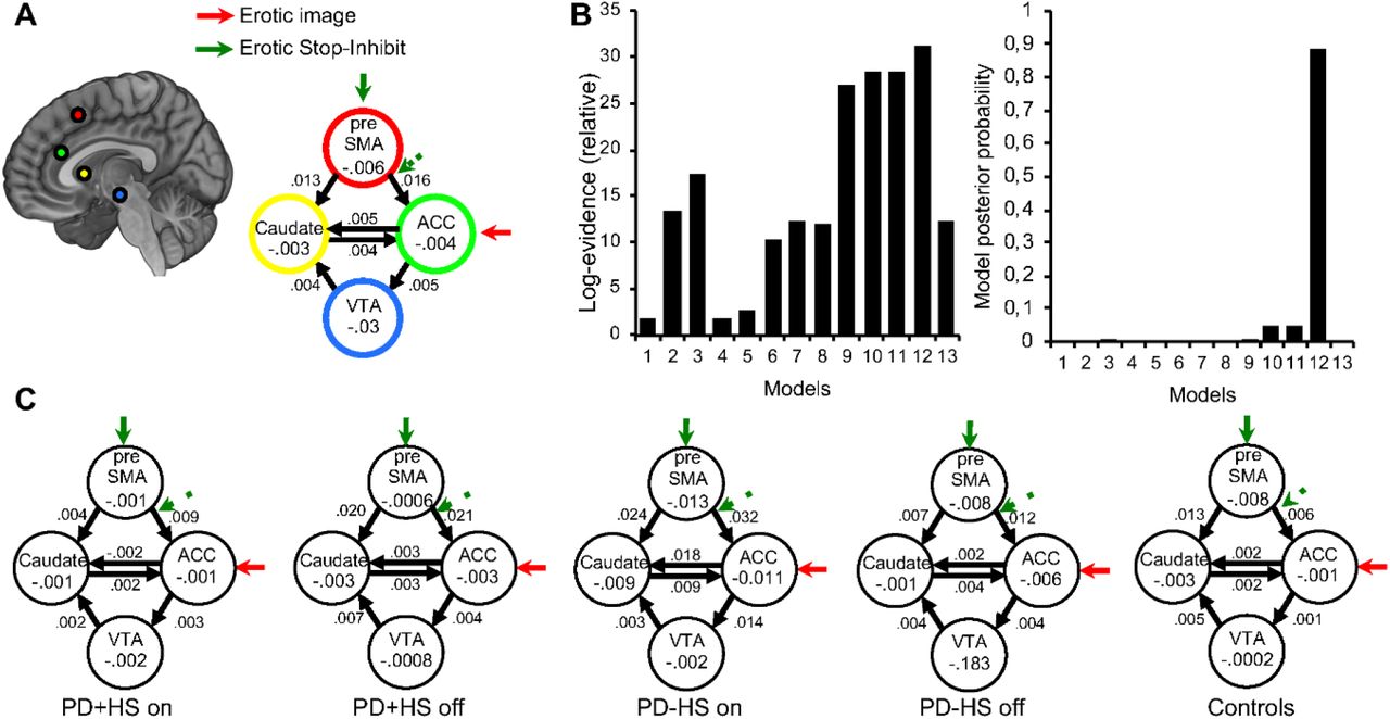 A circuit based approach to repair hypersexuality in Parkinson s