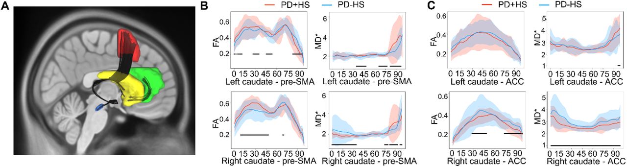 A circuit based approach to repair hypersexuality in Parkinson s