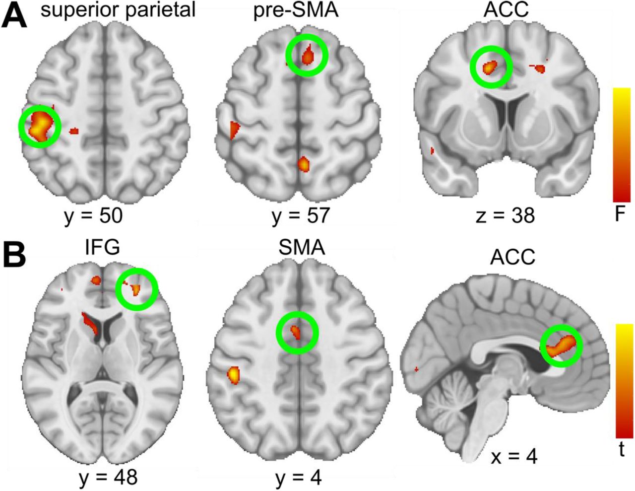 A circuit based approach to repair hypersexuality in Parkinson s