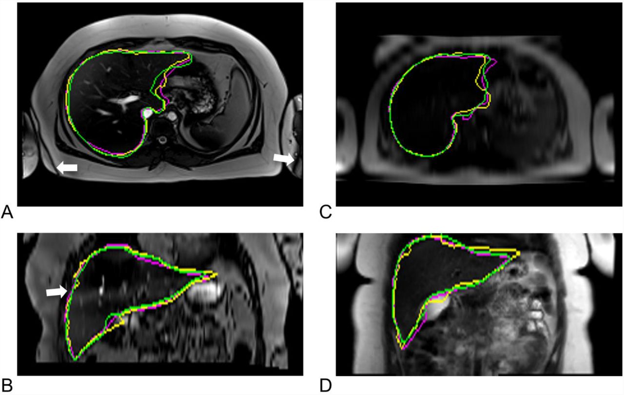 Correlation of MRI-based preoperative breast volumetry and MS volume