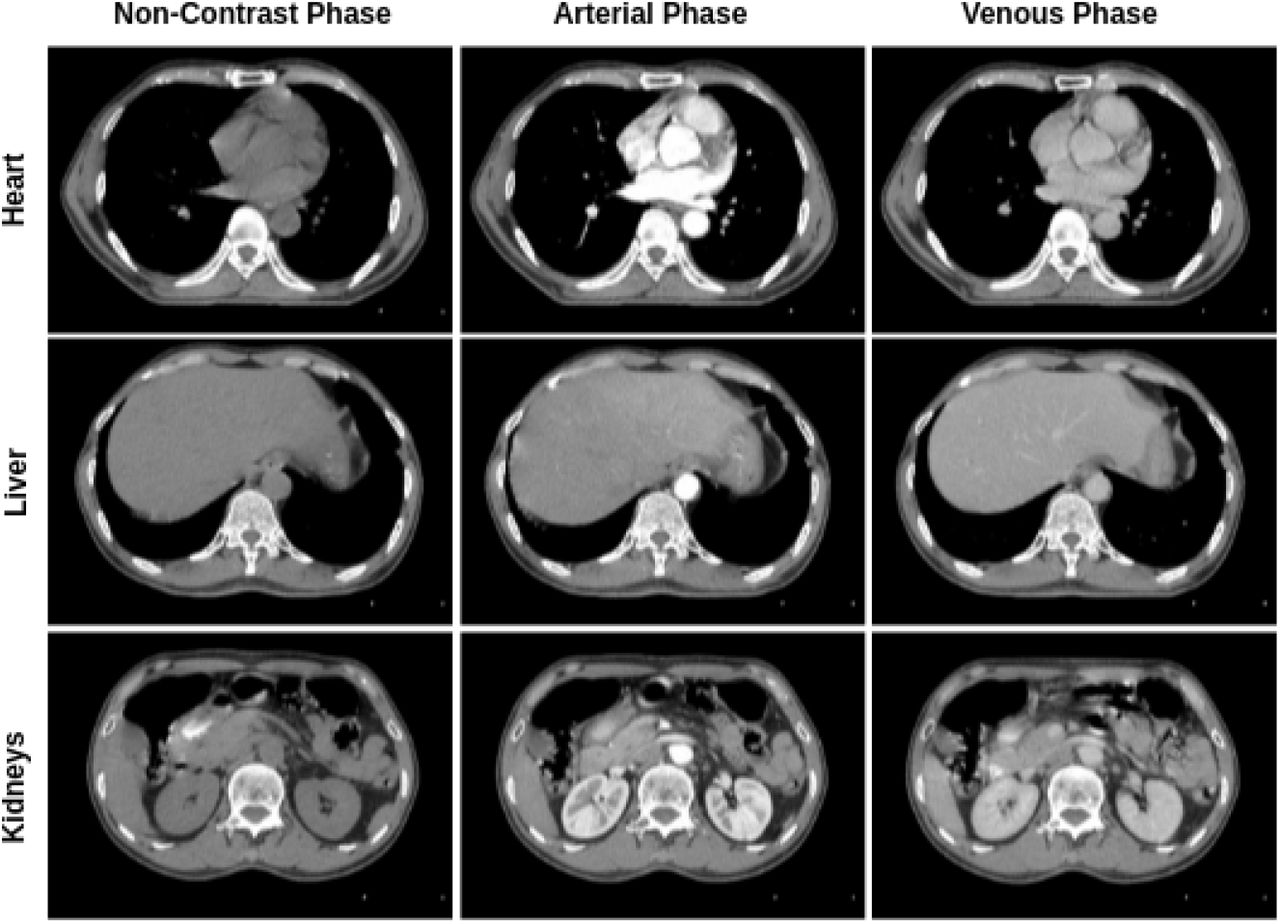 Phase Recognition In Contrast Enhanced Ct Scans Based On Deep Learning And Random Sampling Medrxiv 2791