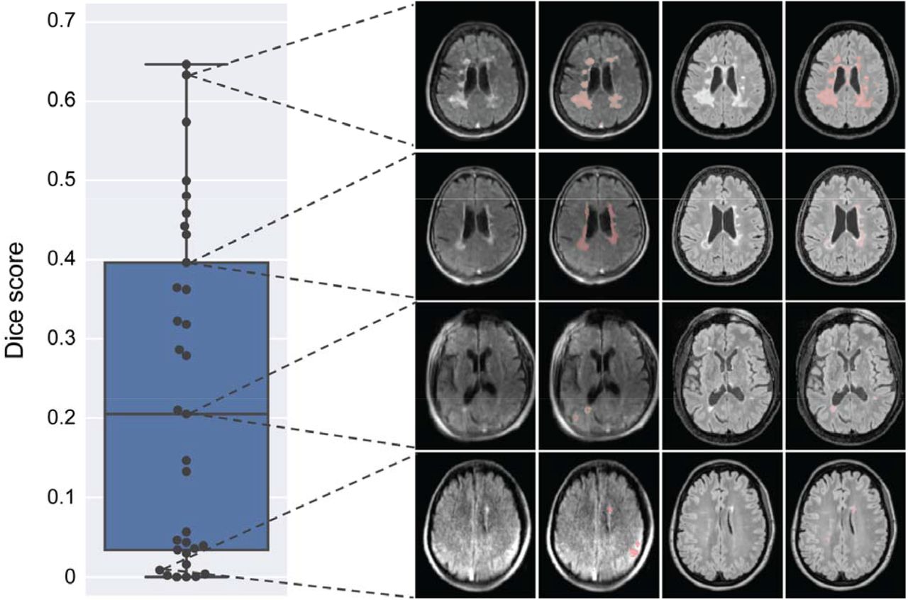 Portable, Low-Field Magnetic Resonance Imaging Sensitively Detects 