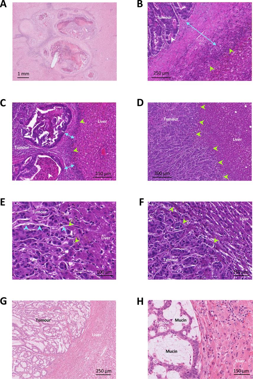 Histopathological growth patterns of liver metastasis: updated consensus  guidelines for pattern scoring, perspectives, and recent mechanistic  insights | medRxiv