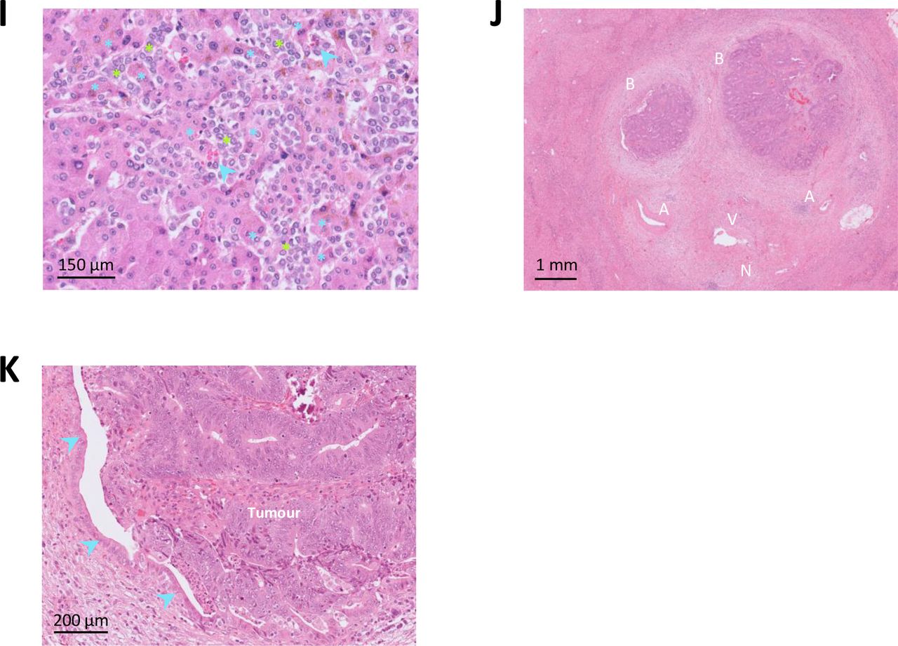 Histopathological growth patterns of liver metastasis: updated consensus  guidelines for pattern scoring, perspectives, and recent mechanistic  insights | medRxiv