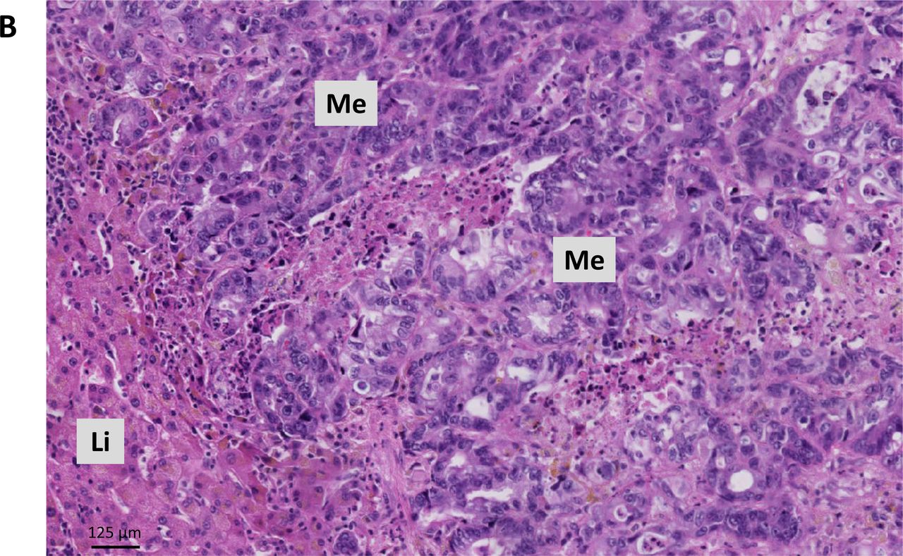 Histopathological growth patterns of liver metastasis: updated consensus  guidelines for pattern scoring, perspectives, and recent mechanistic  insights | medRxiv