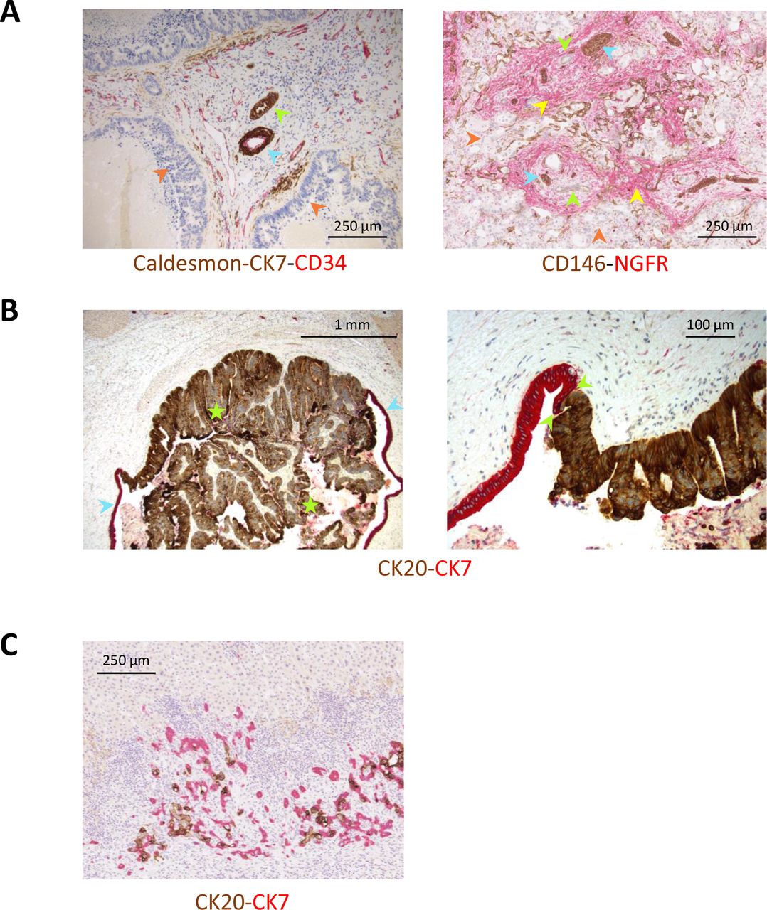 Histopathological growth patterns of liver metastasis: updated consensus  guidelines for pattern scoring, perspectives, and recent mechanistic  insights | medRxiv