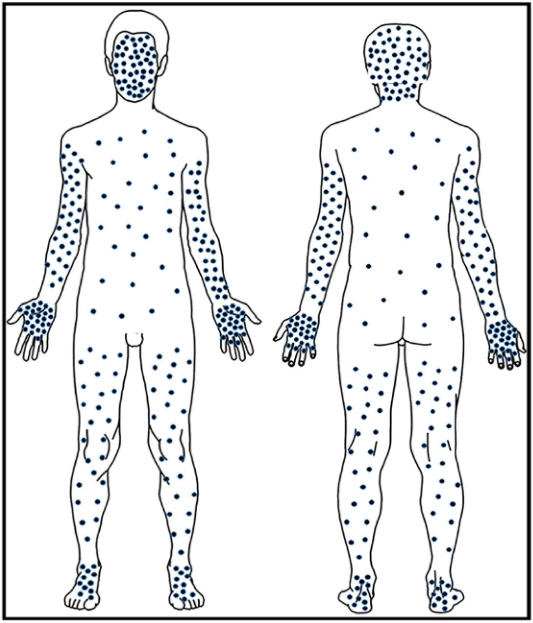 Study describes monkeypox in women; CDC warns of Tpoxx resistance