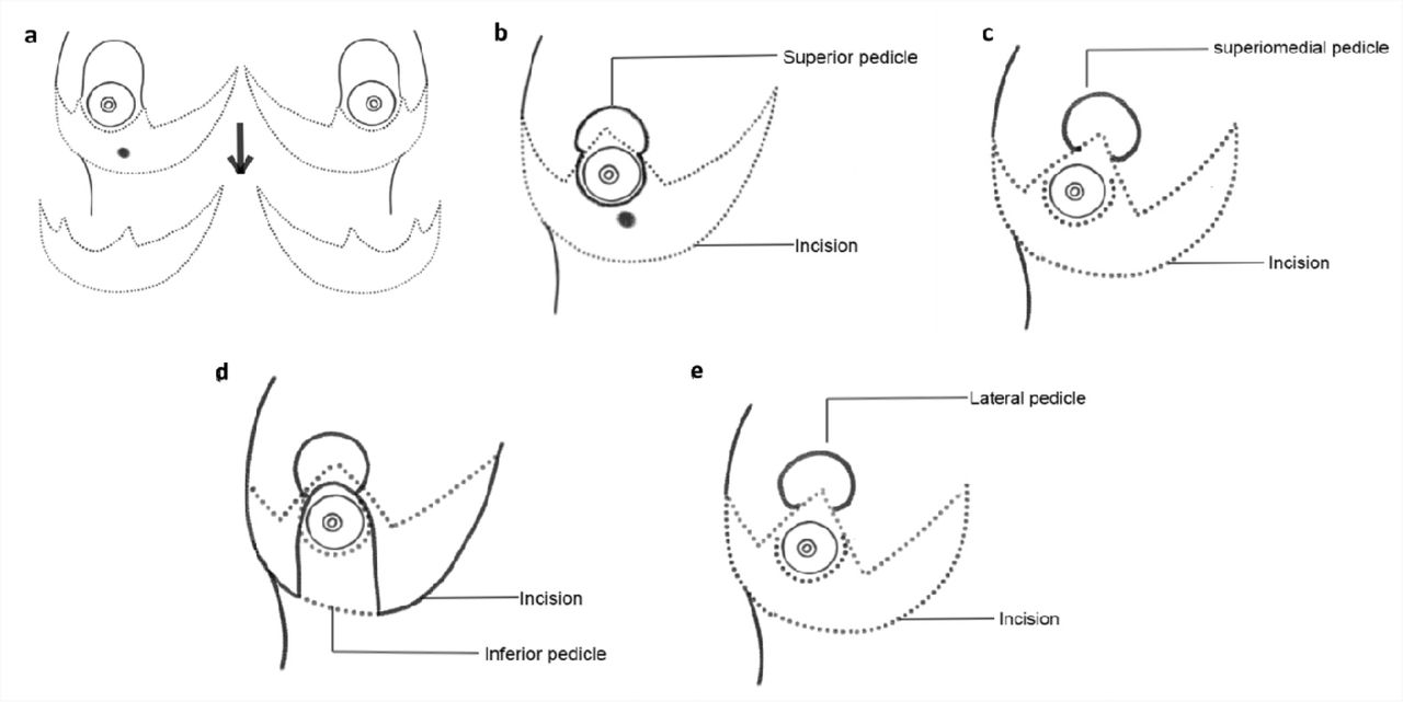 Therapeutic mammoplasty as a viable surgical approach in Breast Cancer  Patients from India: A Single Institutional Audit