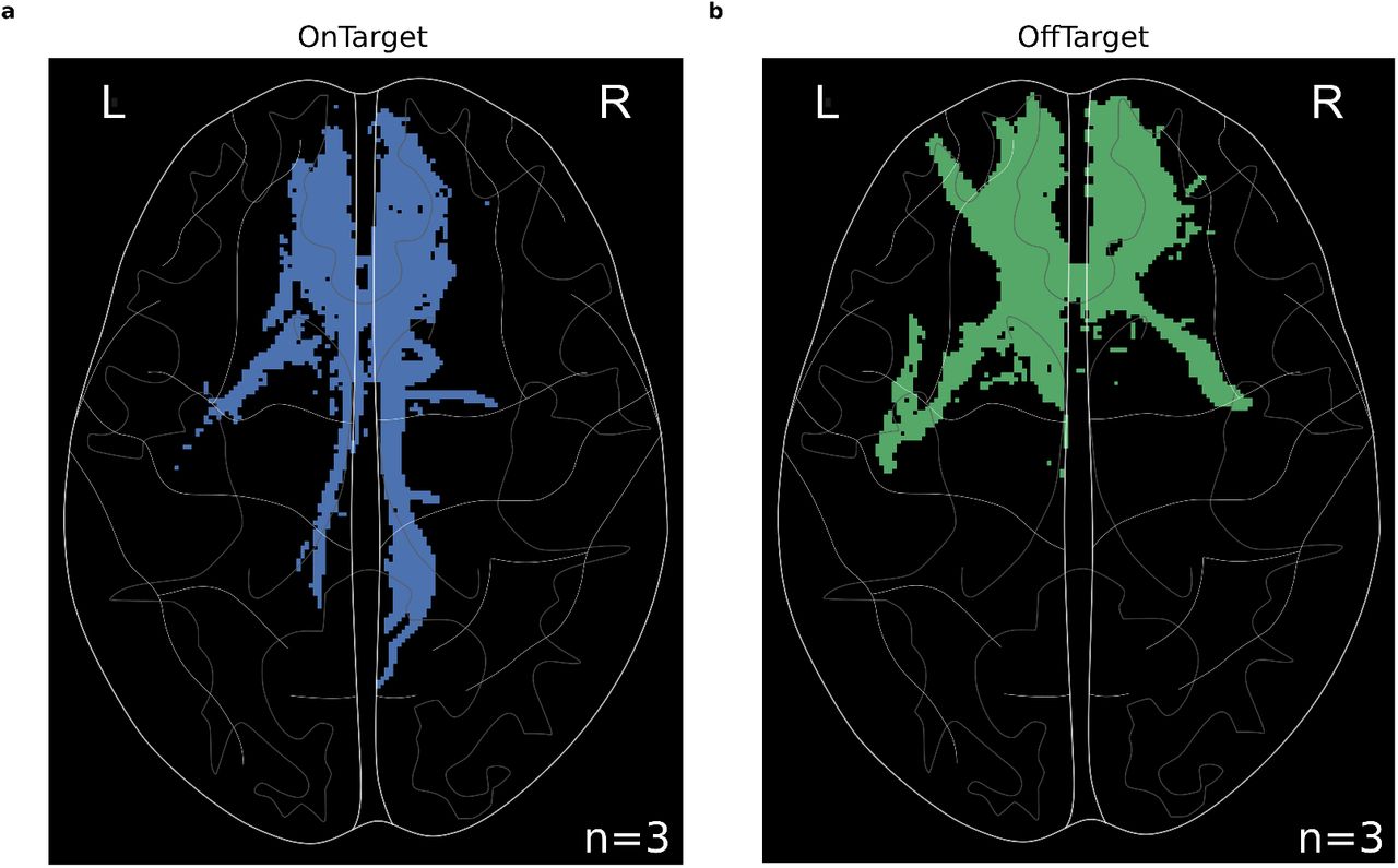 Network Action of Subcallosal Cingulate White Matter Deep Brain Stimulation