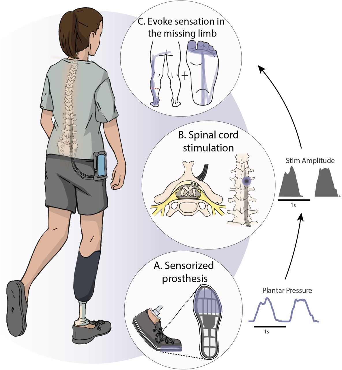 Spinal cord stimulation restores sensation improves function and