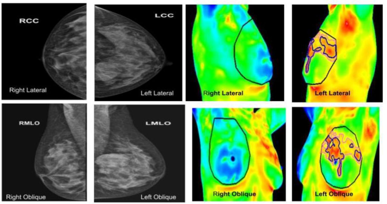 A prospective evaluation of breast thermography enhanced by a