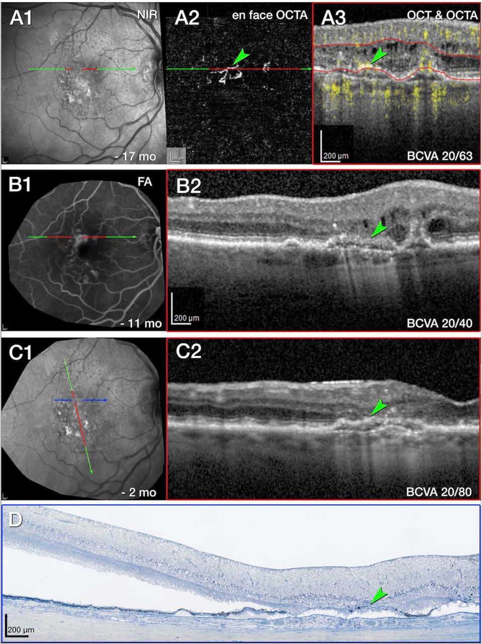 Cystoid Macular Edema Histology