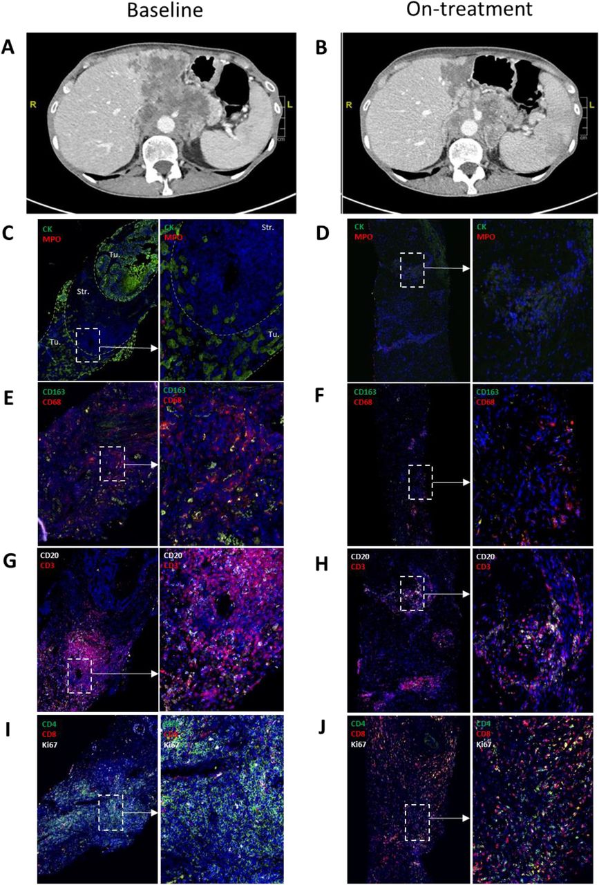 The CSF-1R inhibitor Pexidartinib impacts dendritic cell differentiation  through inhibition of FLT3 signaling and may antagonize the effect of  durvalumab in patients with advanced cancer – results from a phase 1 study |