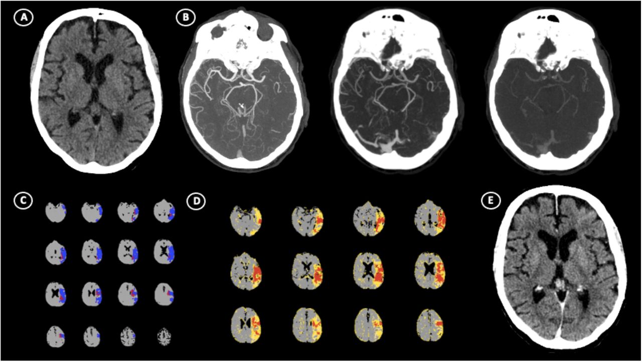 CT-Perfusion absolute Ghost Infarct Core is a rare phenomenon ...